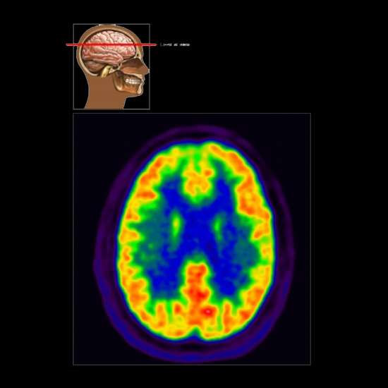 Brain Pet Scan: Preparation, Procedure, and the Requirements